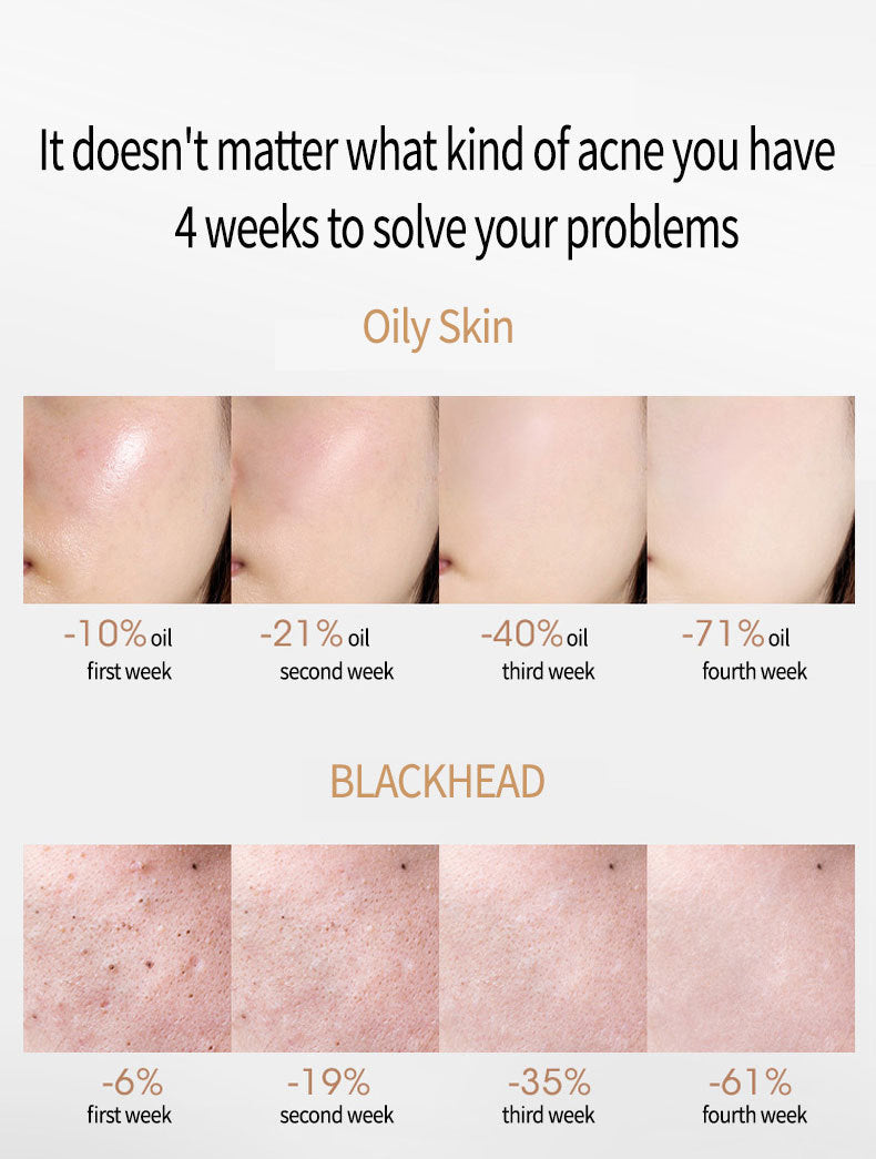 Acne Removing Salicylate Acid Treatment