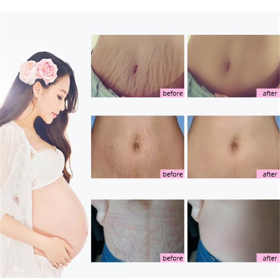 Natural Mango Remove Stretch Mark Cream