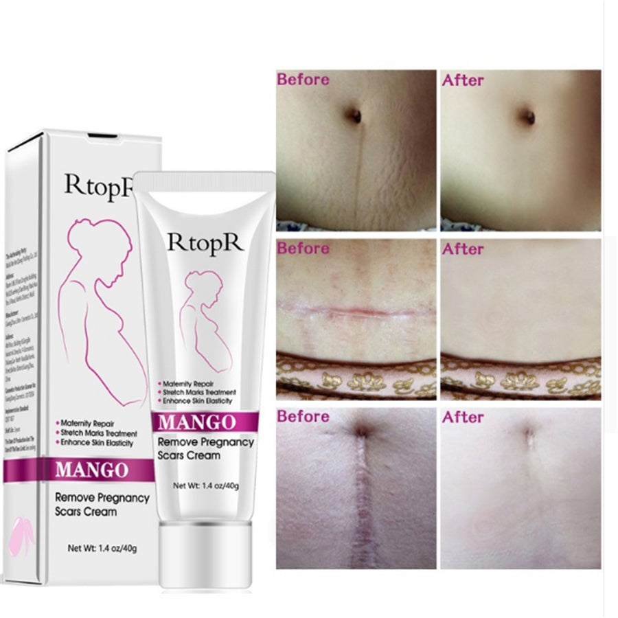 Natural Mango Remove Stretch Mark Cream