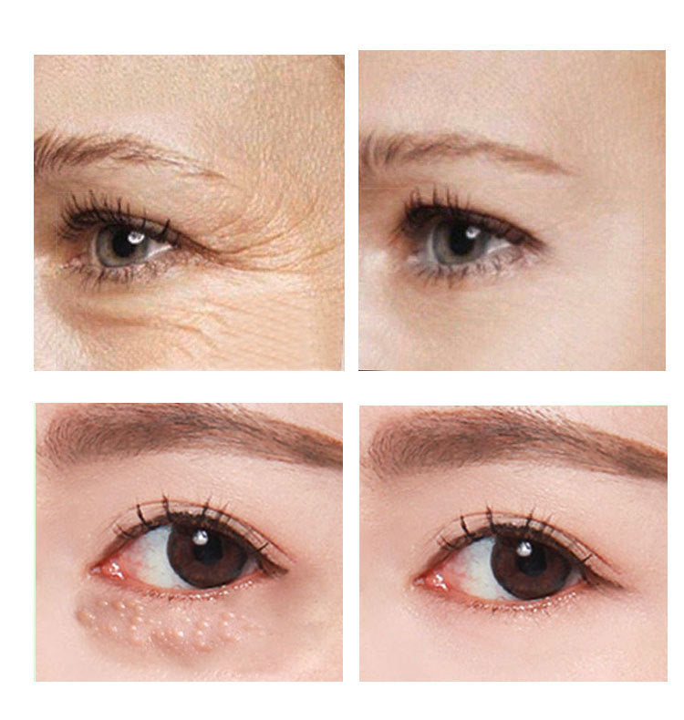 Anti- Wrinkle Eye Treatment